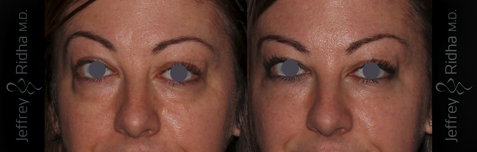 Injectable Fillers Saratoga Springs